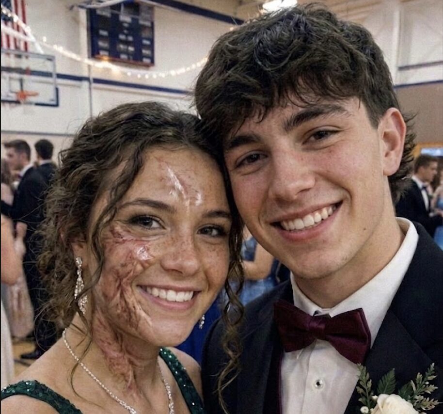 A Boy Asked Me to Dance at Prom Because No One Else Would Due to My Scars